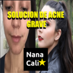 Garantizado Como quitar las espinillas los barritos o acné de forma natural sin medicamento rápido casos extremos y severos